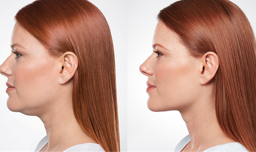 Double Chin Fat Reduction Injections Mississauga Oakville